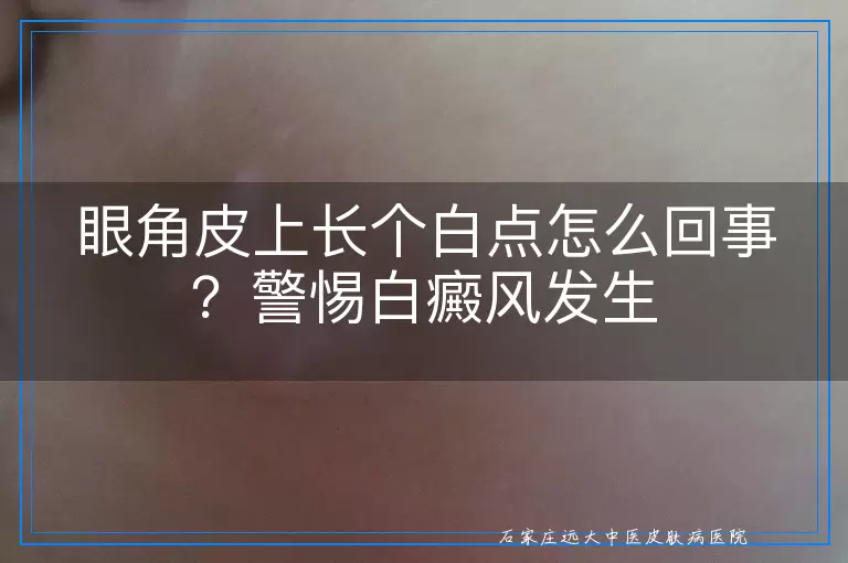 眼角皮上长个白点怎么回事?警惕白癜风发生