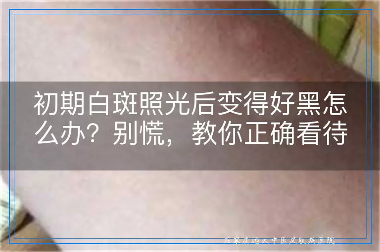 初期白斑照光后变得好黑怎么办?别慌,教你正确看待与护理
