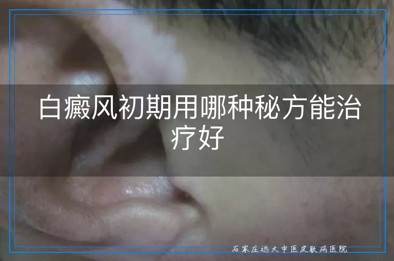 白癜风初期用哪种秘方能治疗好