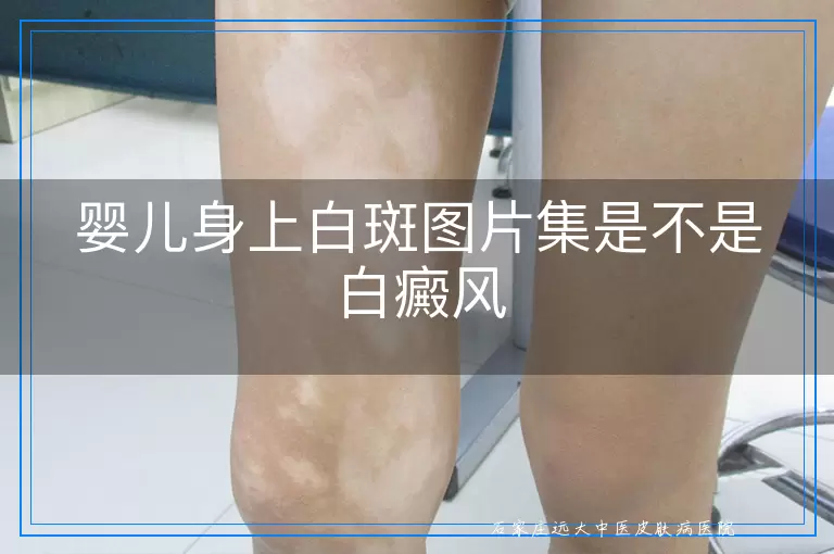 婴儿身上白斑图片集是不是白癜风