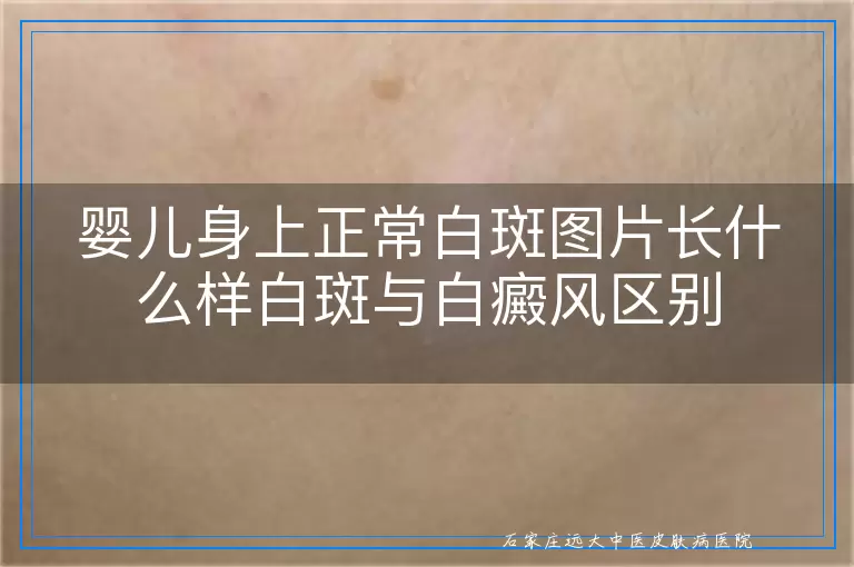 婴儿身上正常白斑图片长什么样白斑与白癜风区别