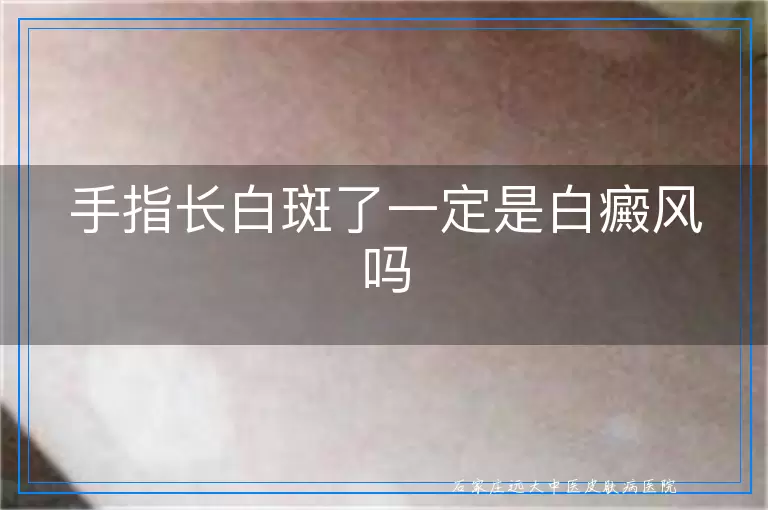 手指长白斑了一定是白癜风吗