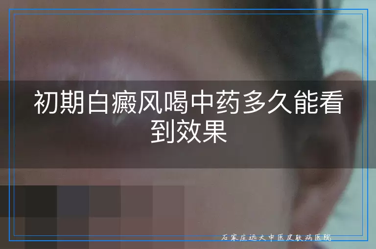 初期白癜风喝中药多久能看到效果