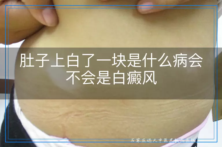 肚子上白了一块是什么病会不会是白癜风
