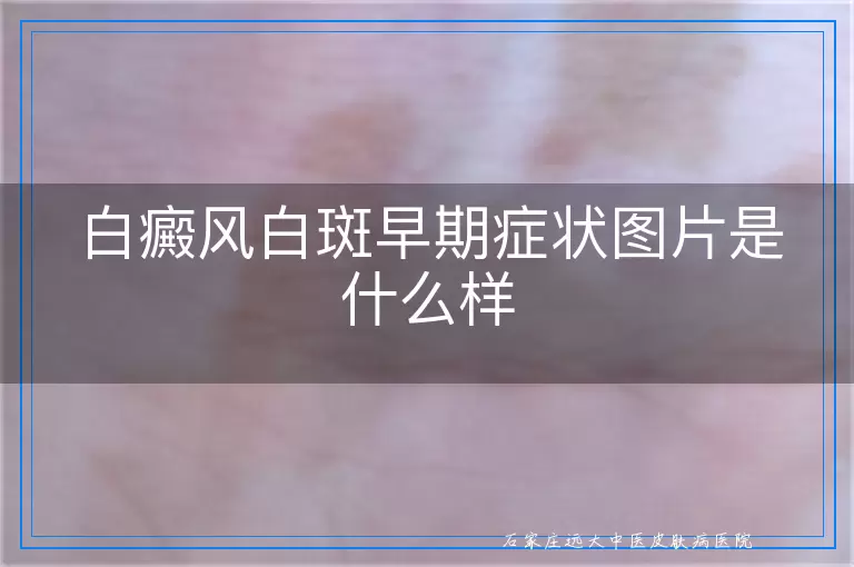 白癜风白斑早期症状图片是什么样