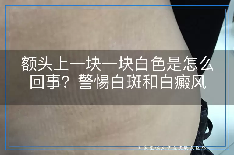 额头上一块一块白色是怎么回事？警惕白斑和白癜风