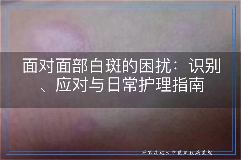 面对面部白斑的困扰：识别、应对与日常护理指南