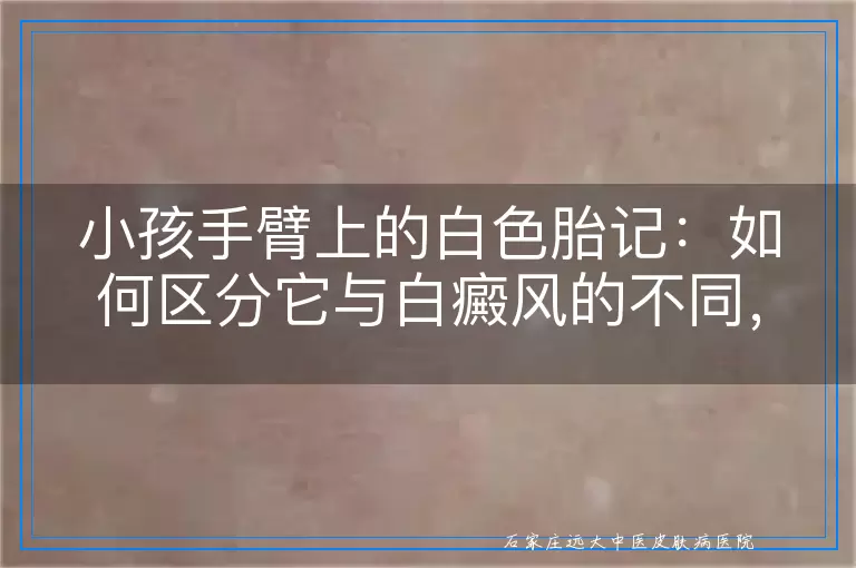 小孩手臂上的白色胎记：如何区分它与白癜风的不同，家长必读指南