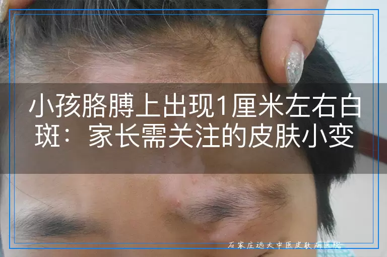 小孩胳膊上出现1厘米左右白斑：家长需关注的皮肤小变化及其可能含义