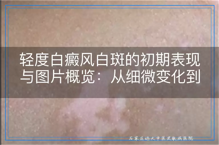 轻度白癜风白斑的初期表现与图片概览：从细微变化到视觉识别