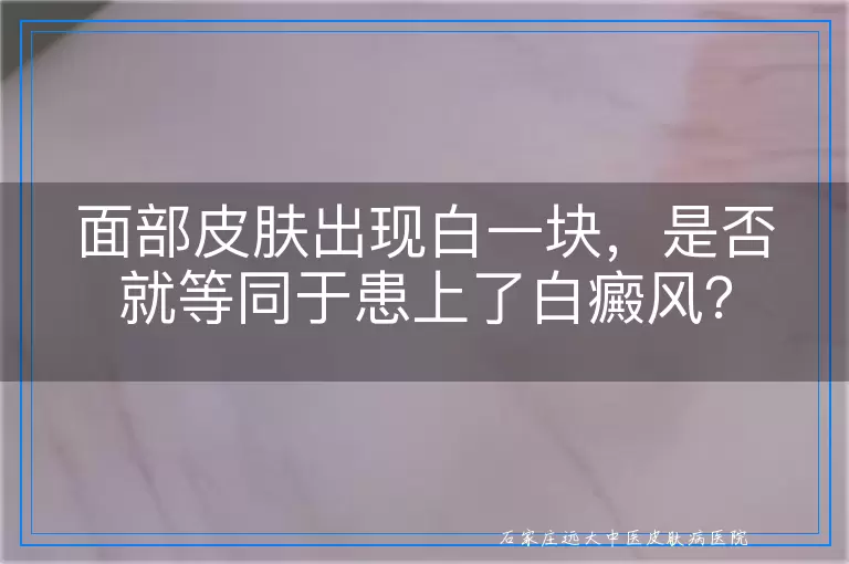 面部皮肤出现白一块，是否就等同于患上了白癜风？