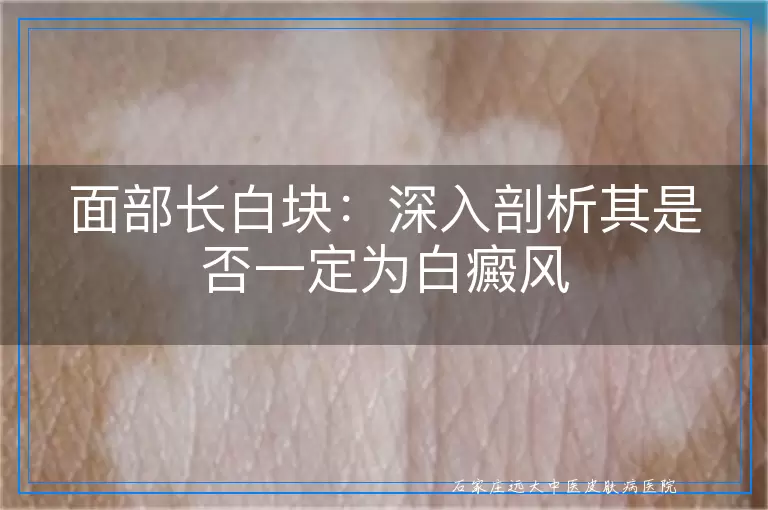 面部长白块：深入剖析其是否一定为白癜风