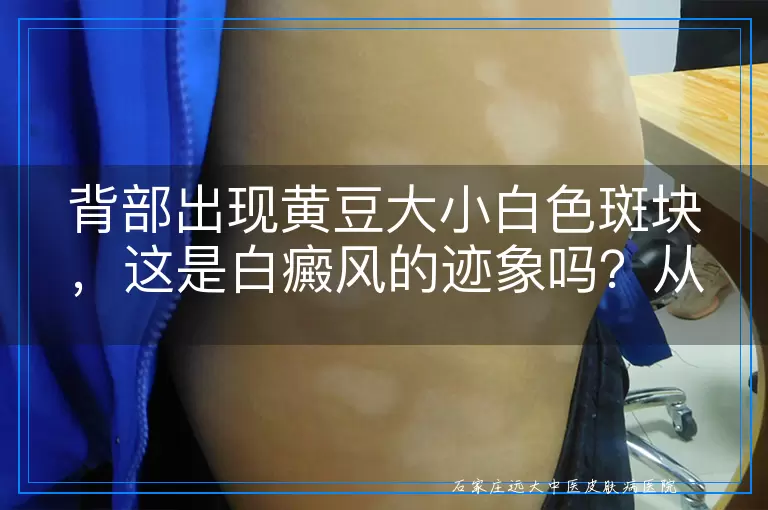 背部出现黄豆大小白色斑块，这是白癜风的迹象吗？从多角度为你解答