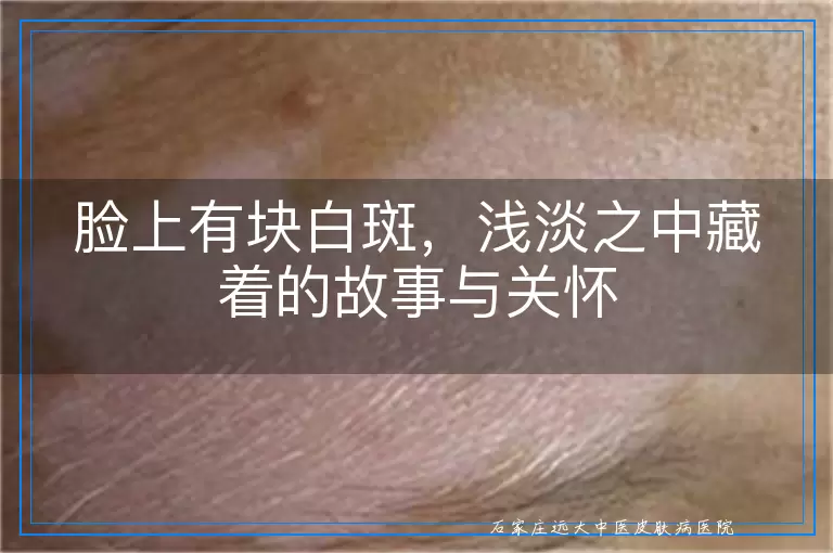 脸上有块白斑，浅淡之中藏着的故事与关怀