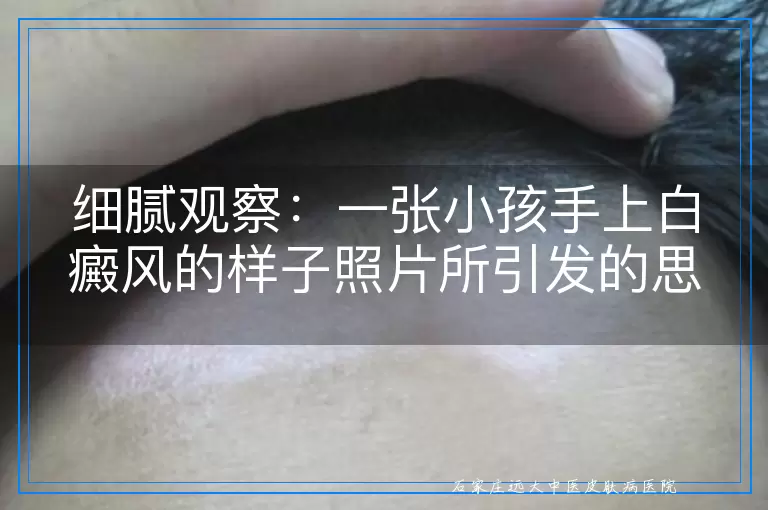 细腻观察：一张小孩手上白癜风的样子照片所引发的思考与关怀