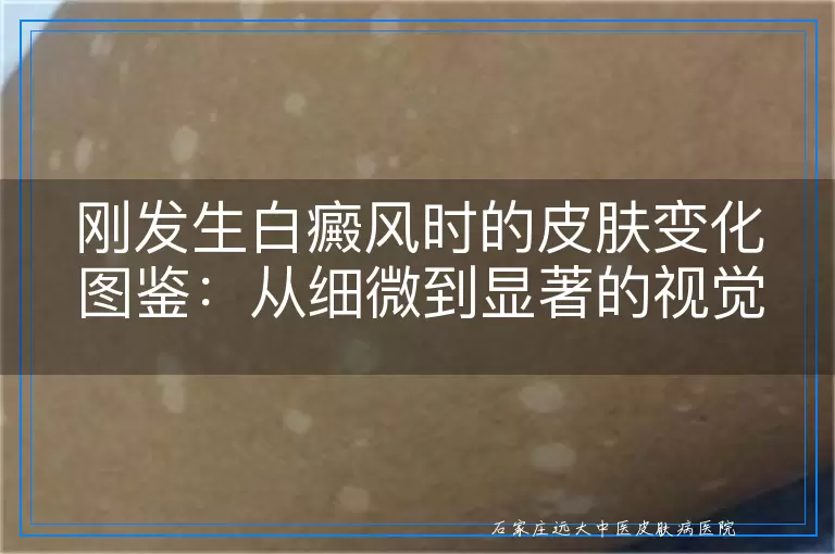 刚发生白癜风时的皮肤变化图鉴：从细微到显著的视觉记录