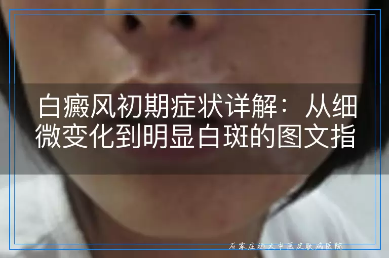 白癜风初期症状详解：从细微变化到明显白斑的图文指南