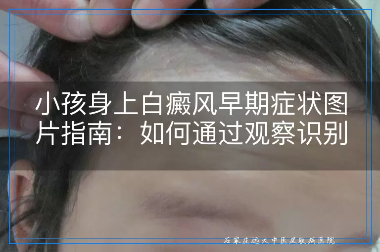 小孩身上白癜风早期症状图片指南：如何通过观察识别白斑