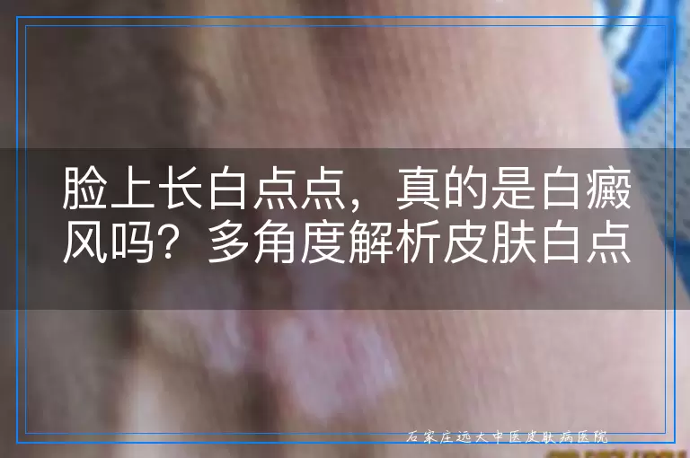 脸上长白点点，真的是白癜风吗？多角度解析皮肤白点成因