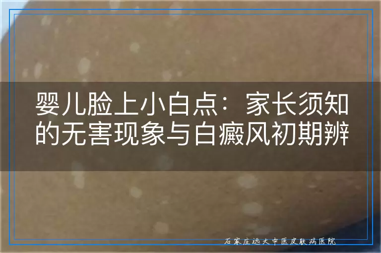 婴儿脸上小白点：家长须知的无害现象与白癜风初期辨识