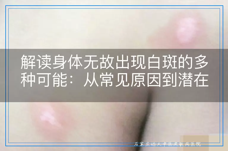 解读身体无故出现白斑的多种可能：从常见原因到潜在健康信号