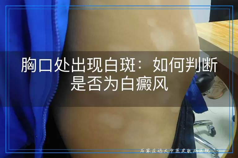 胸口处出现白斑：如何判断是否为白癜风