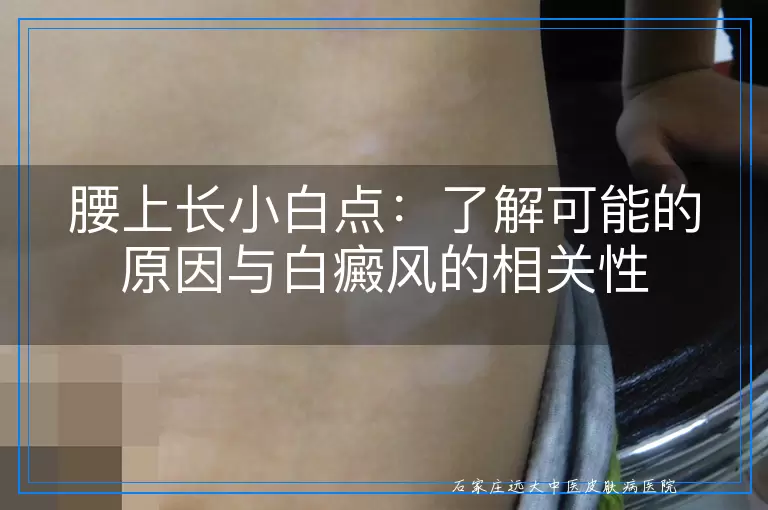 腰上长小白点：了解可能的原因与白癜风的相关性