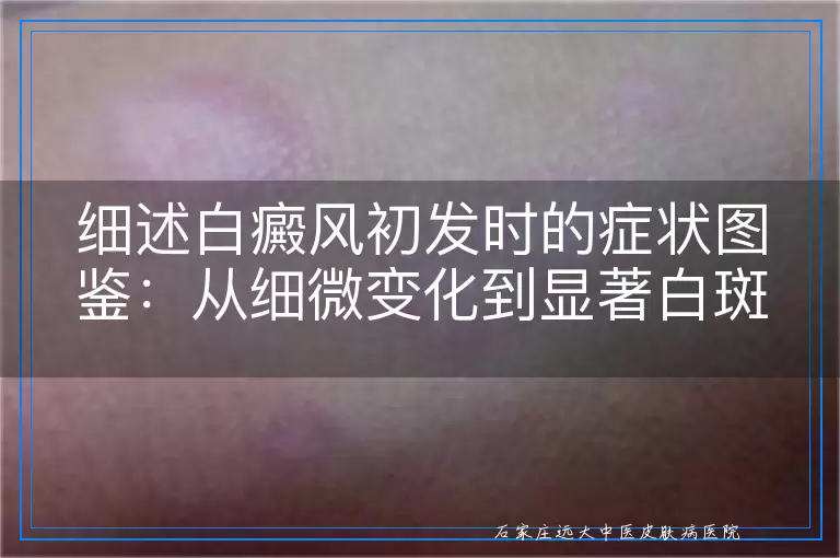 细述白癜风初发时的症状图鉴：从细微变化到显著白斑的演变