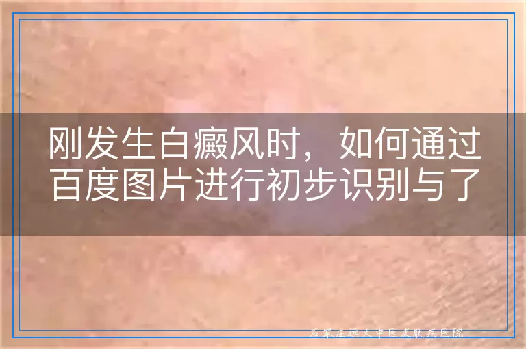 刚发生白癜风时，如何通过百度图片进行初步识别与了解