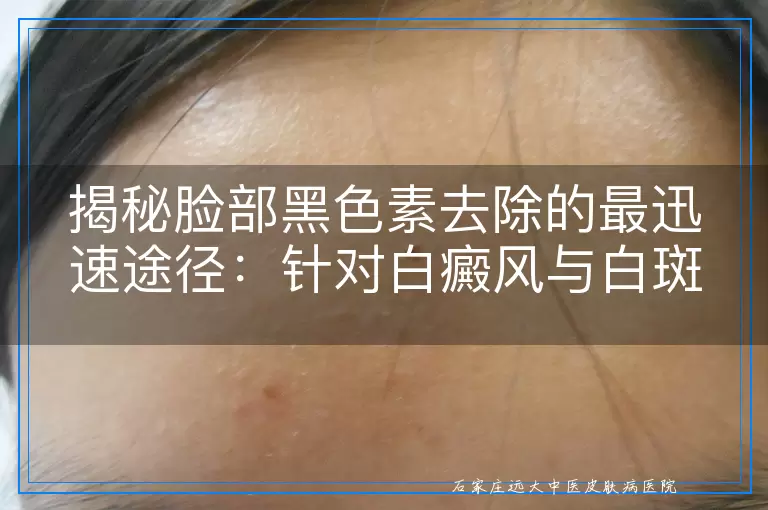 揭秘脸部黑色素去除的最迅速途径：针对白癜风与白斑的有效疗法