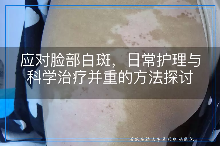 应对脸部白斑，日常护理与科学治疗并重的方法探讨