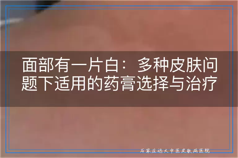面部有一片白：多种皮肤问题下适用的药膏选择与治疗建议