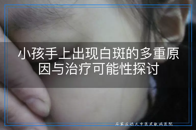 小孩手上出现白斑的多重原因与治疗可能性探讨
