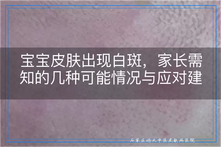 宝宝皮肤出现白斑，家长需知的几种可能情况与应对建议