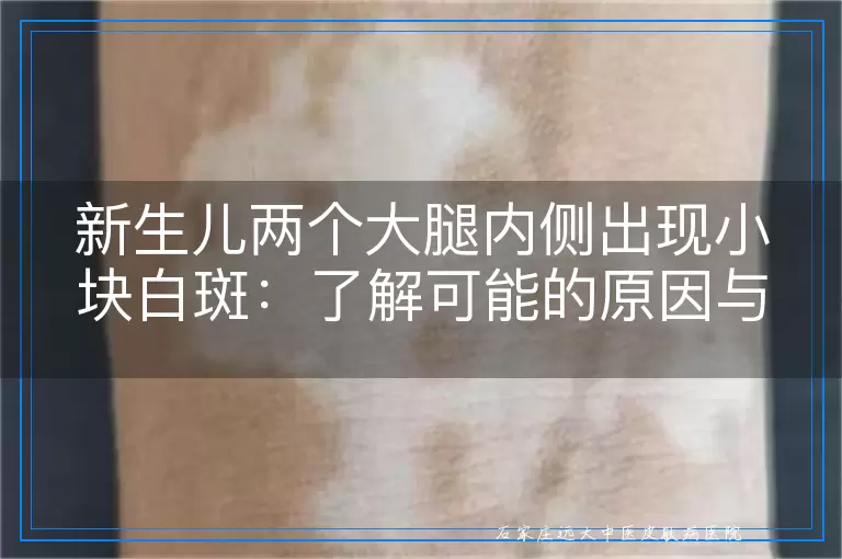 新生儿两个大腿内侧出现小块白斑：了解可能的原因与家长应对策略