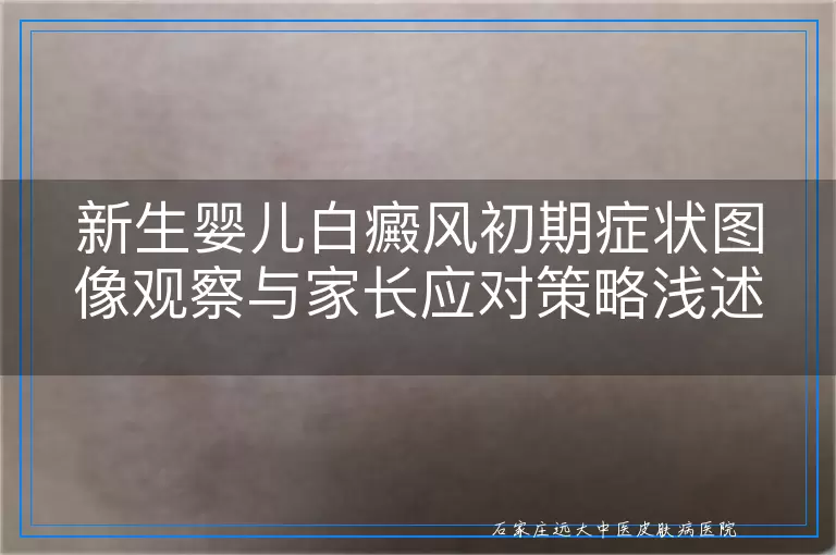 新生婴儿白癜风初期症状图像观察与家长应对策略浅述