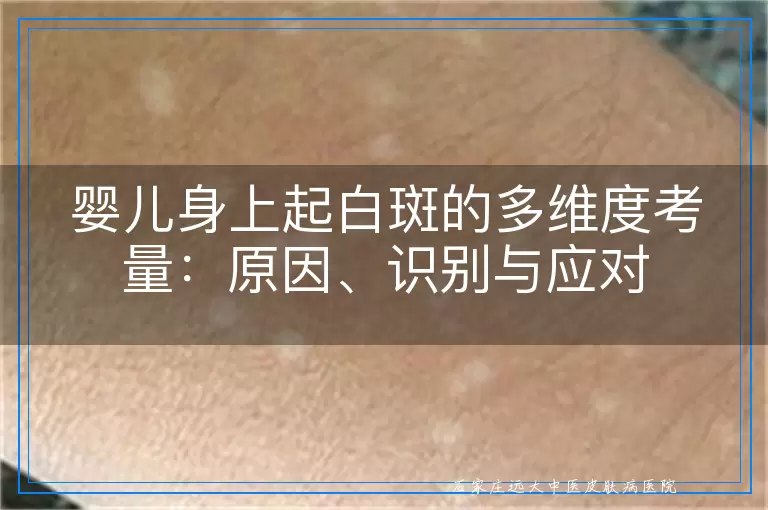 婴儿身上起白斑的多维度考量：原因、识别与应对