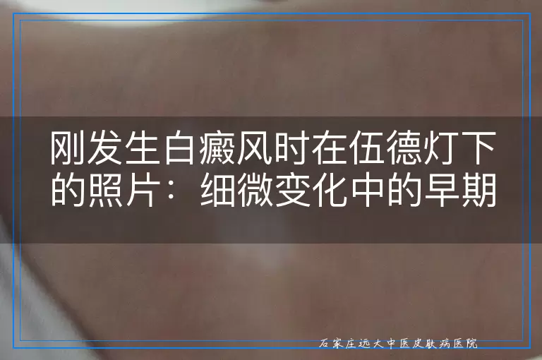 刚发生白癜风时在伍德灯下的照片：细微变化中的早期警示与观察