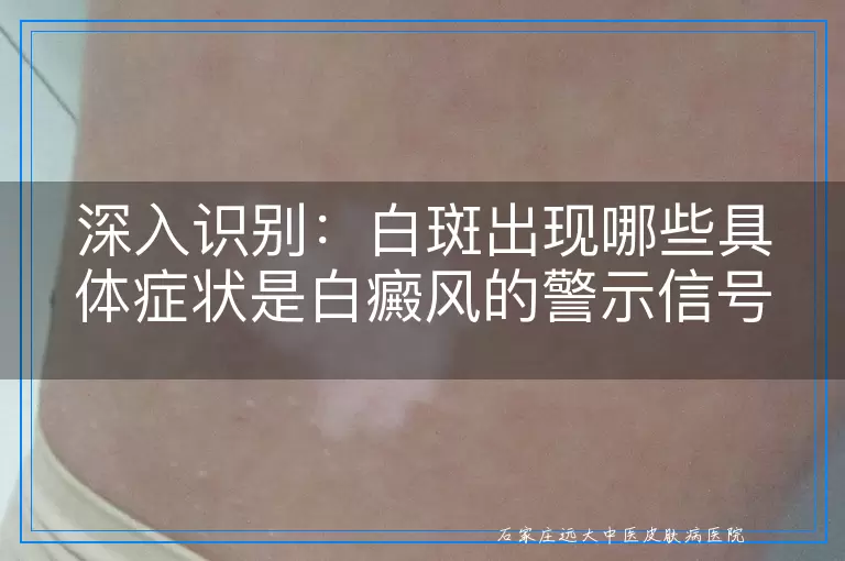 深入识别：白斑出现哪些具体症状是白癜风的警示信号？