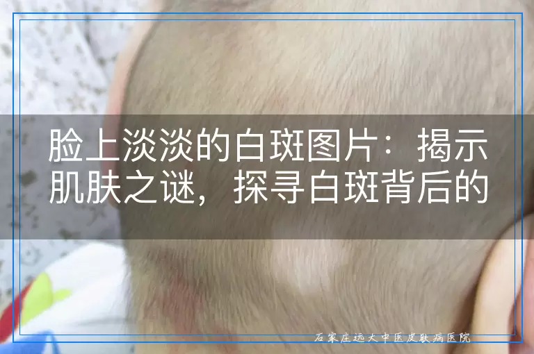 脸上淡淡的白斑图片：揭示肌肤之谜，探寻白斑背后的故事
