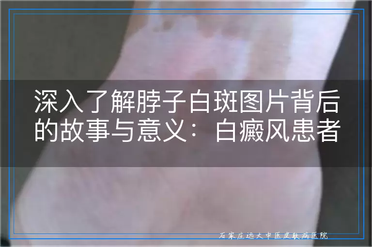 深入了解脖子白斑图片背后的故事与意义：白癜风患者的心声