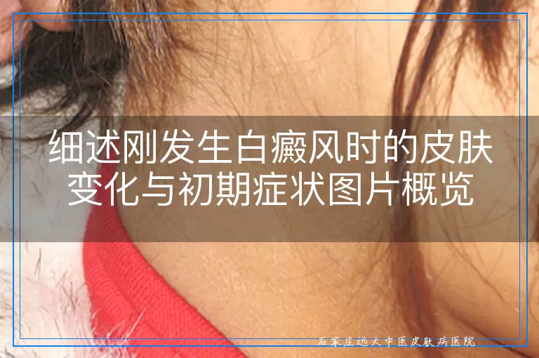细述刚发生白癜风时的皮肤变化与初期症状图片概览