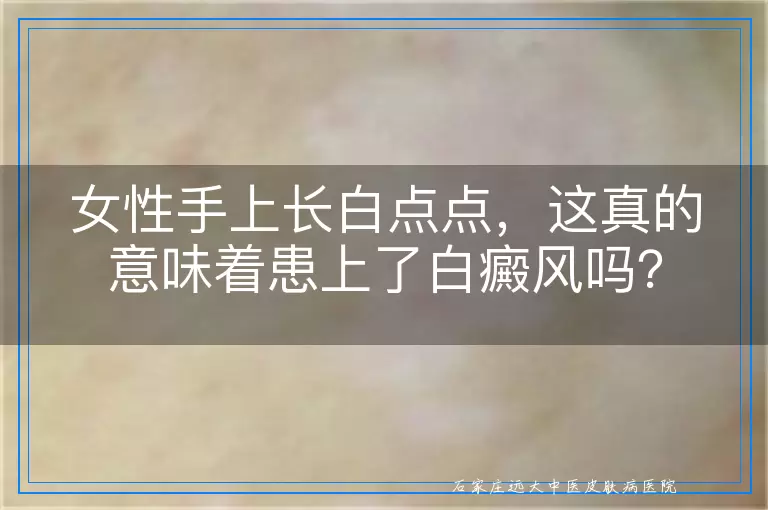 女性手上长白点点，这真的意味着患上了白癜风吗？
