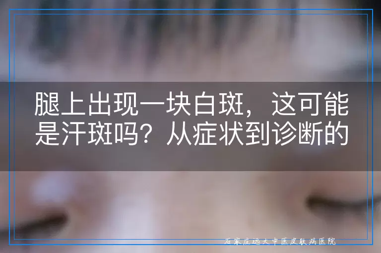 腿上出现一块白斑，这可能是汗斑吗？从症状到诊断的全面考量