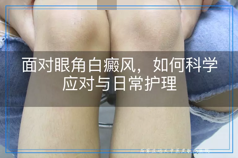 面对眼角白癜风，如何科学应对与日常护理