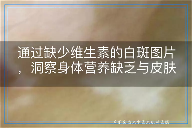 通过缺少维生素的白斑图片，洞察身体营养缺乏与皮肤健康的微妙联系