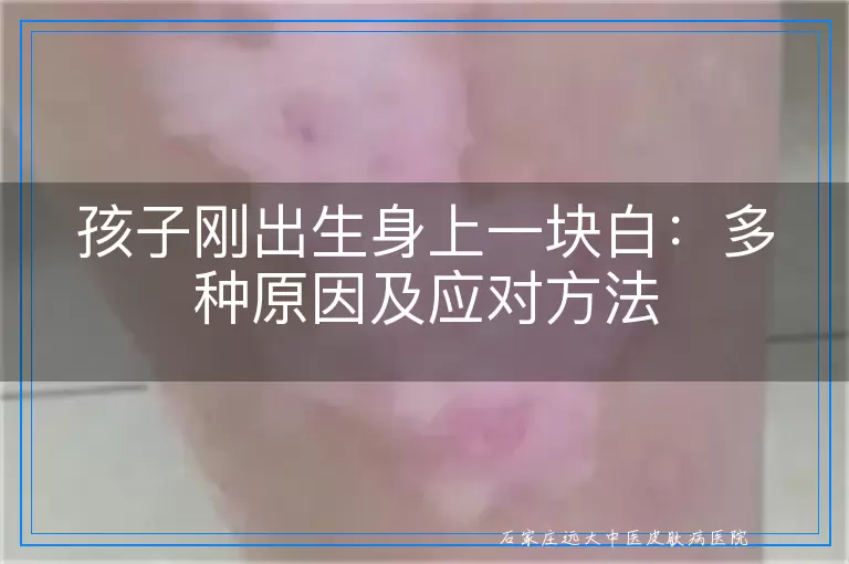 孩子刚出生身上一块白：多种原因及应对方法