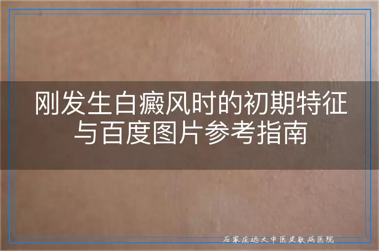 刚发生白癜风时的初期特征与百度图片参考指南