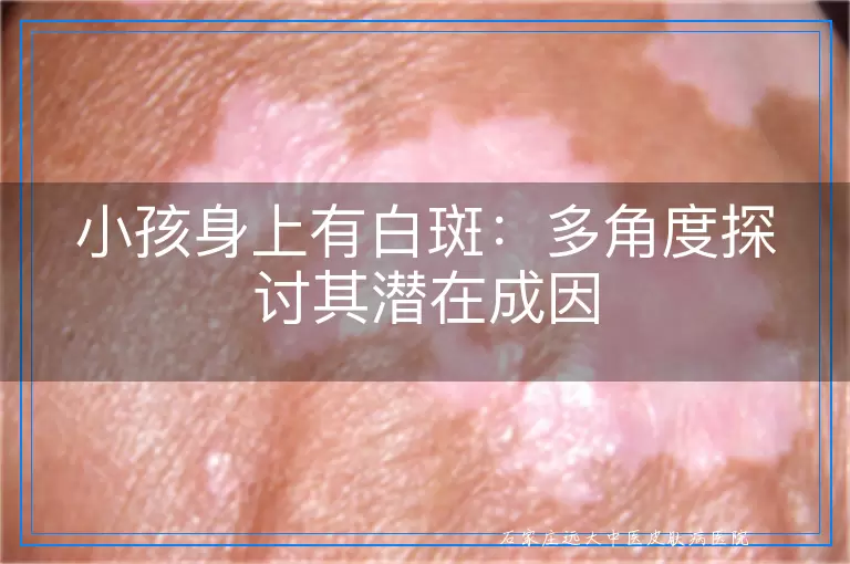 小孩身上有白斑：多角度探讨其潜在成因