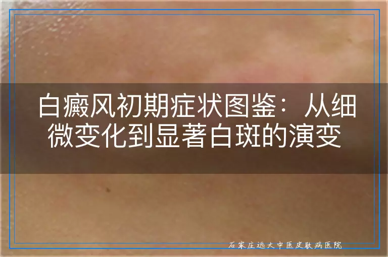 白癜风初期症状图鉴：从细微变化到显著白斑的演变
